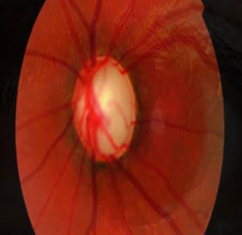 Glaucoma service