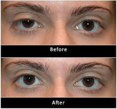 Ptosis service